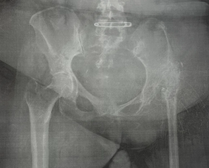 Radiograph of Freida's pelvic region